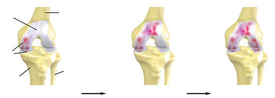 Artroosi etapid